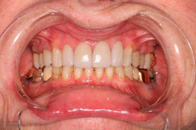 Anterior Crowns (After)