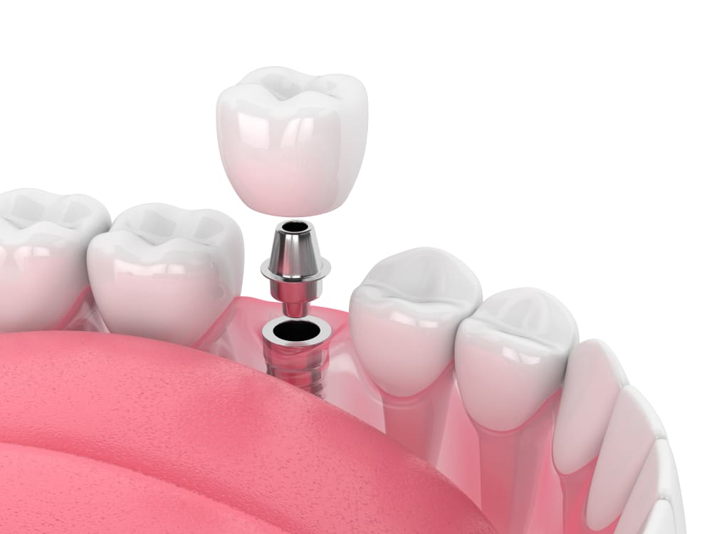 dental implants in kirkland, wa